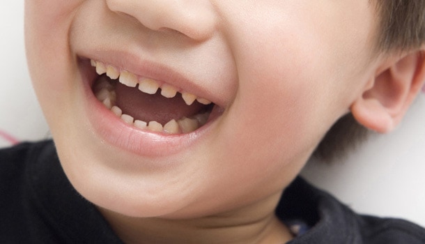 防止蛀牙致过早拔除乳齿-幼童护齿四大法则.jpg