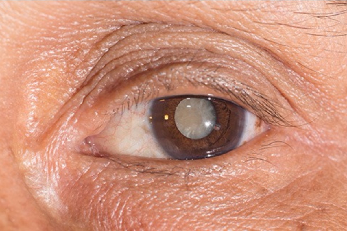 cataract-1-yg24i5.jpg