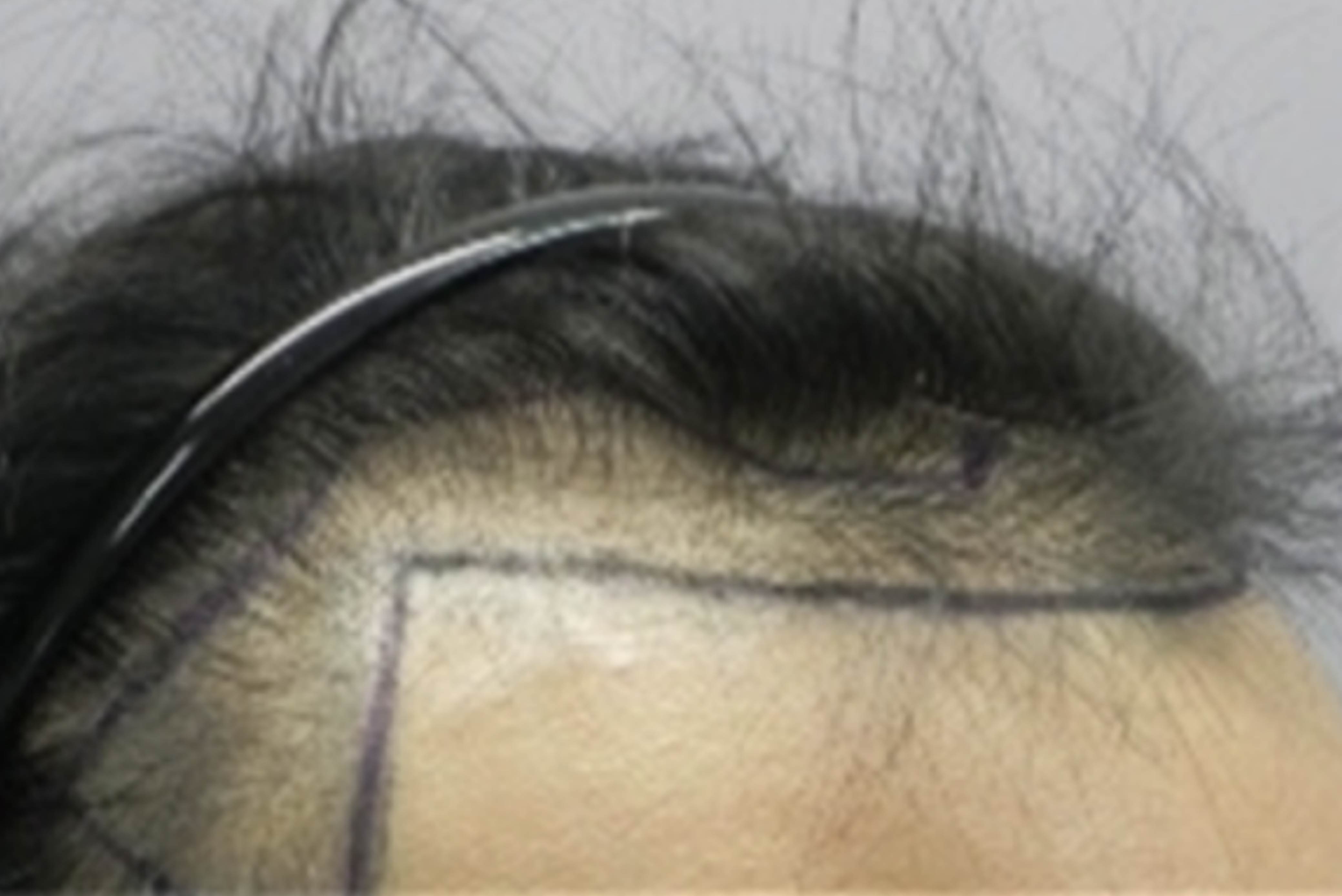 20230310_EHC_[髮理專家問答] 詳細講解FUE植髮手術-ML-06.jpg
