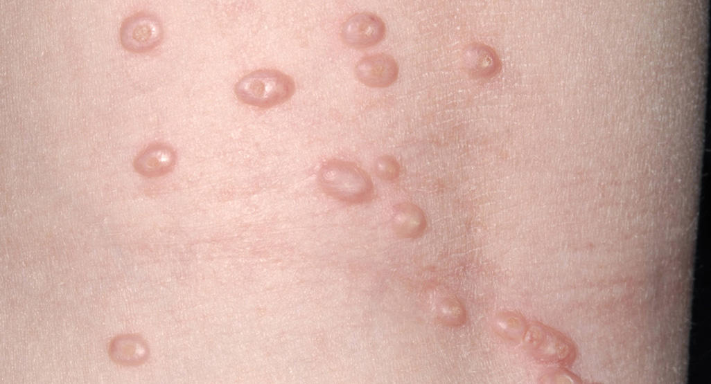 Molluscum contagiosum (water warts) in children ages one to five -  BabyCentre UK