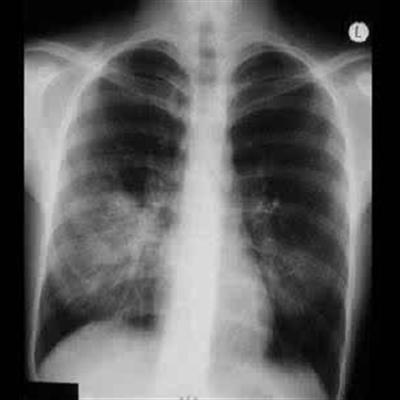 肺部积液是怎么回事_39健康经验