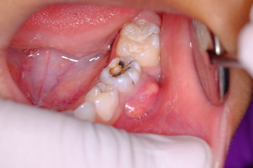 智慧齿不够位生长-蛀牙-牙周病-冠周炎-牙齿囊肿1-520x346.jpg