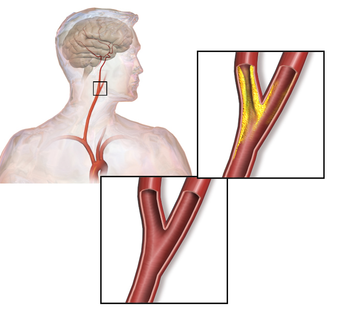Carotid artery stenosis - Wikipedia